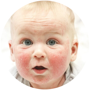 Atopowe zapalenie skóru u niemowląt i dzieci - czym się charakteryzuje?