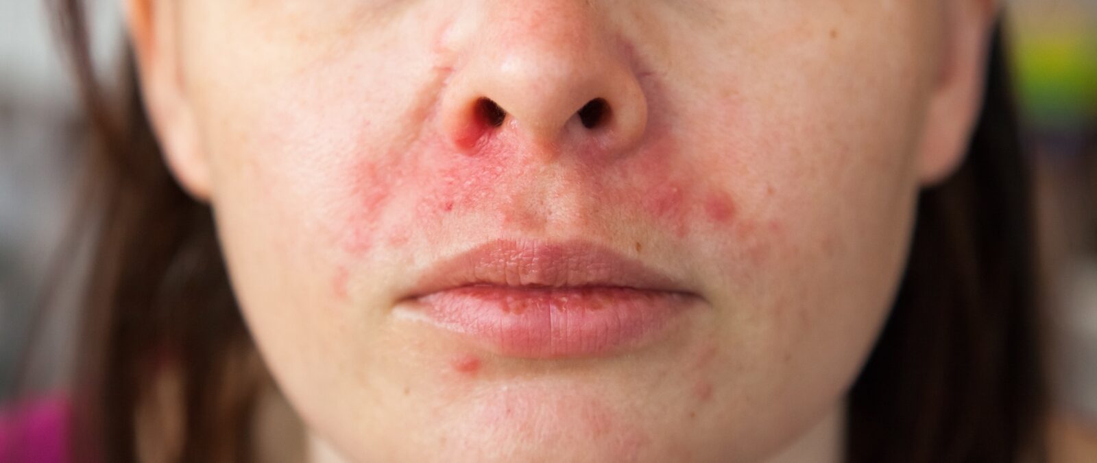 Łojotokowe zapalenie skóry twarzy - na czym polega